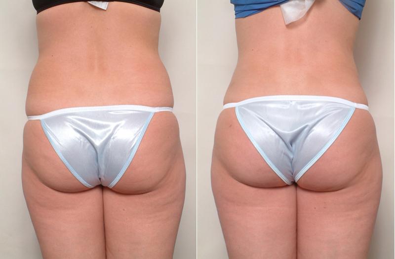 Uso do Ultrassom na Estética | Antes e Depois Costas