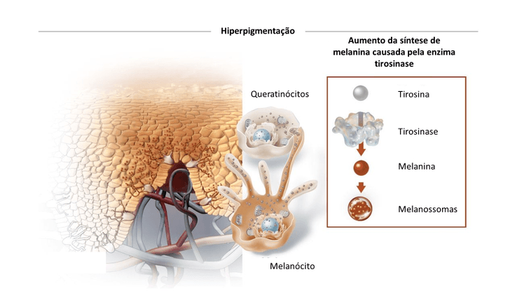 Hiperpigmentação Pós Inflamatória - Esteticista Como Você