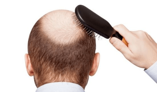 Alopecia Androgênica