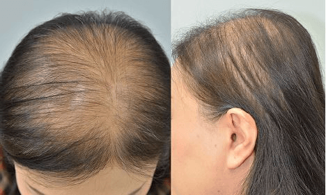 Alopecia Feminina