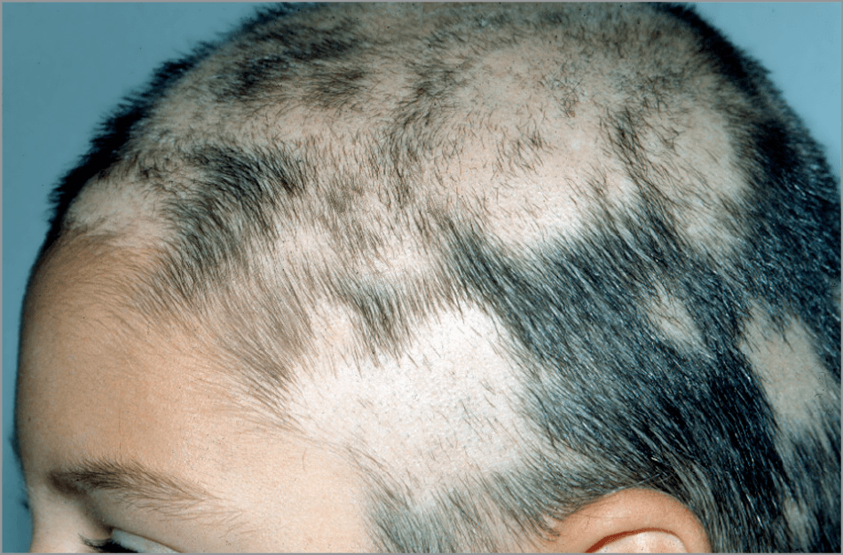 Alopecia Areata