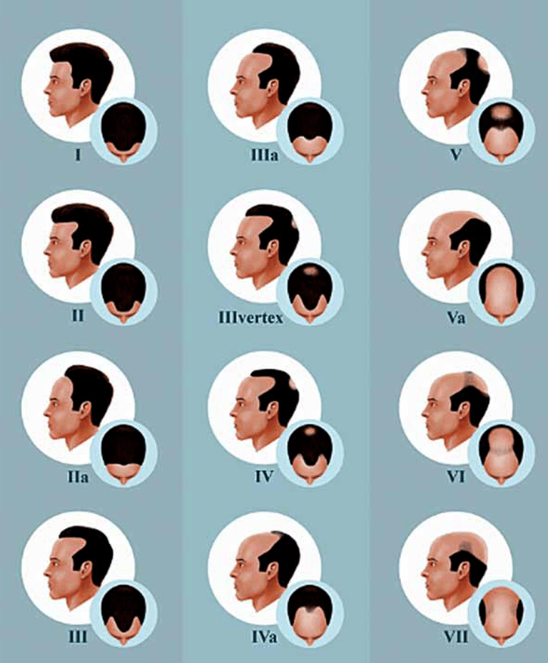 O que é Alopecia ou Calvície e como tratar Esteticista Como Você O que é Alopecia ou Calvície e como tratar Esteticista Como Você
