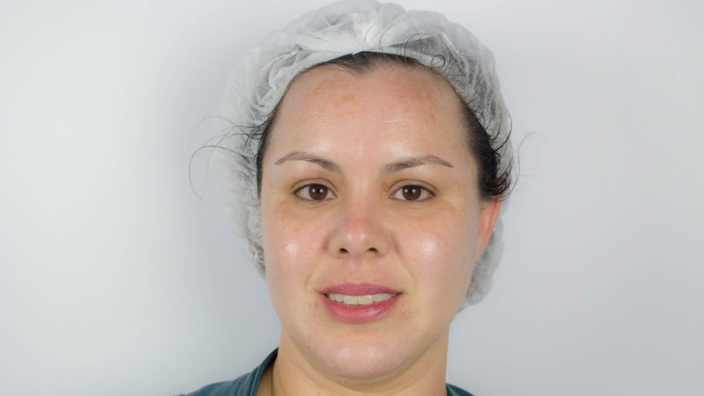 Depois do Tratamento de Melasma