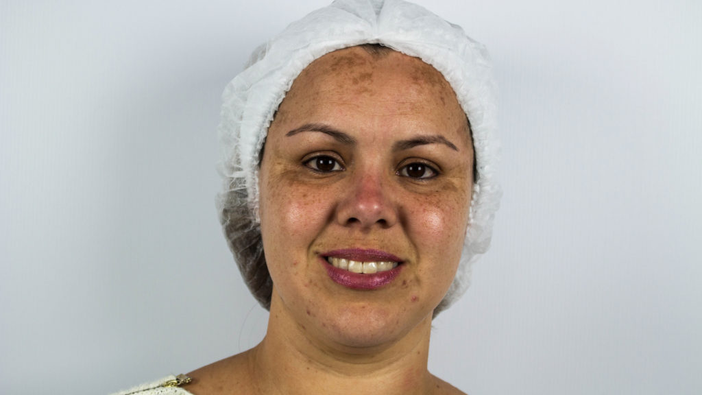Melasma Antes do Tratamento