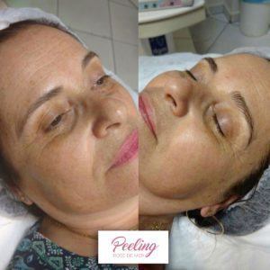 Antes-e-Depois-2-300x300