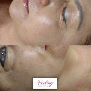 Antes-e-Depois-8-300x300