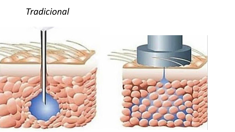 intradermo-normal-x-pressurizada