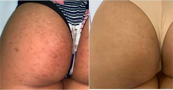 BUMBUM