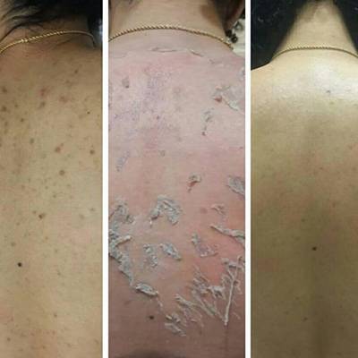 antes-depois-peeling-1