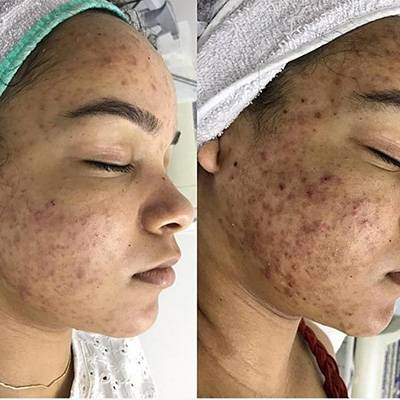 antes-depois-peeling-10