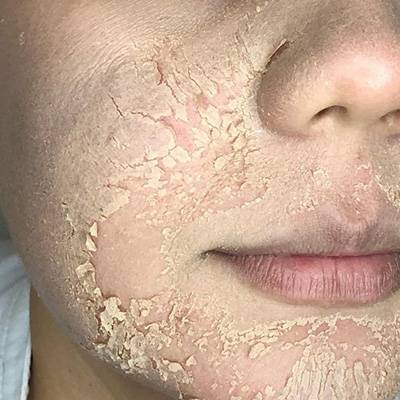 antes-depois-peeling-11