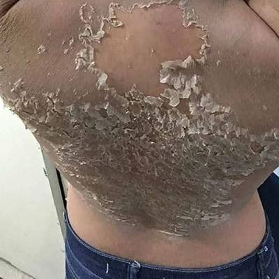 antes-depois-peeling-12