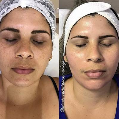 antes-depois-peeling-13