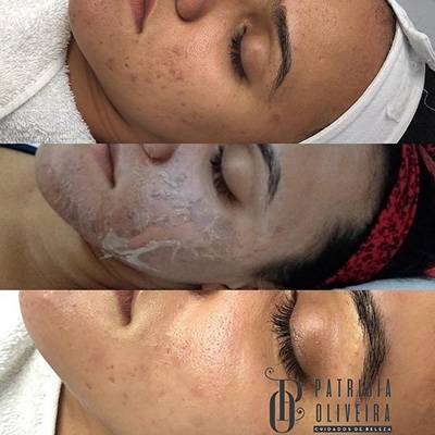 antes-depois-peeling-15