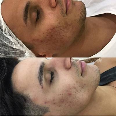antes-depois-peeling-16