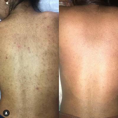 antes-depois-peeling-17