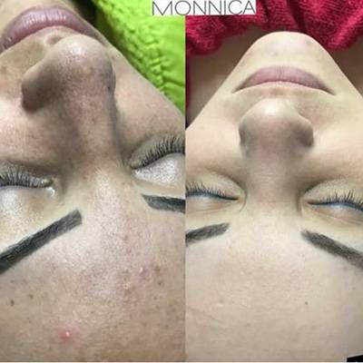 antes-depois-peeling-2