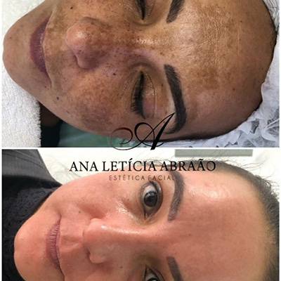 antes-depois-peeling-4