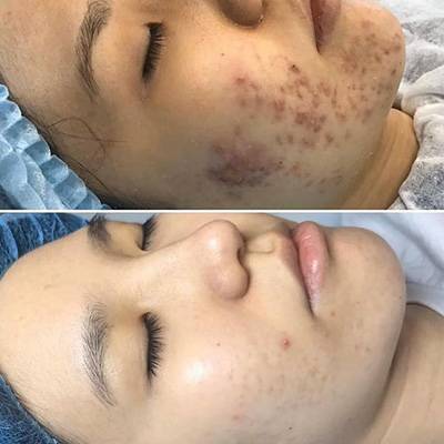 antes-depois-peeling-5