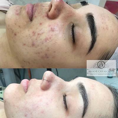 antes-depois-peeling-6