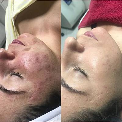 antes-depois-peeling-7