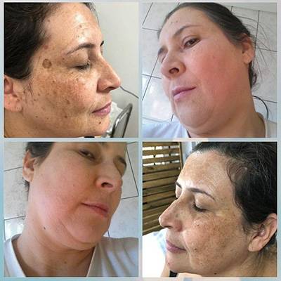 antes-depois-peeling-8