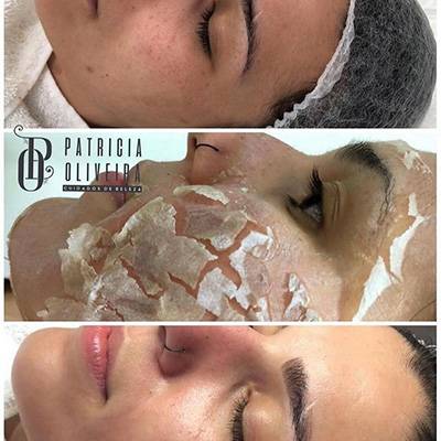 antes-depois-peeling-9