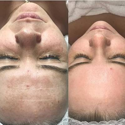 antes-depois-peeling